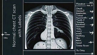 quotNormal Chest CT Scan Explained Detailed Anatomy with Labelsquot [upl. by Ariahs]