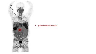 Neuroendocrine tumour treatment at the Peter MacCallum Cancer Centre [upl. by Reinnej]