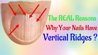 The REAL Reasons Why Your Nails Have Vertical How to Treat and Fix Vertical Ridges [upl. by Saihttam]