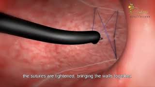 ENDOSCOPIC SLEEVE GASTROPLASTY [upl. by Donegan478]