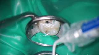 Tooth sealing with calcium silicate based sealer amp bulkfill composite [upl. by Teddman]