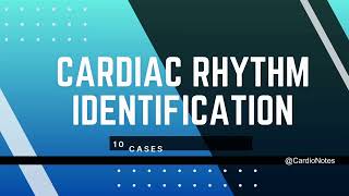 ECG Rhythm Analysis on Hospital Monitor  What these Lines Tell Us [upl. by Viguerie]