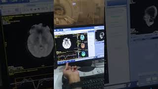 MRI Brain Perfusion post processing GE [upl. by Aizitel]