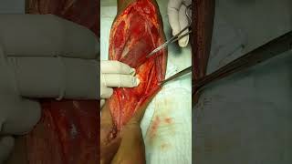 antomy of forearm of pt during fasciotomy [upl. by Galvan535]