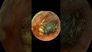 COMPLETE Package Of Earwax With Fungi [upl. by Fein]