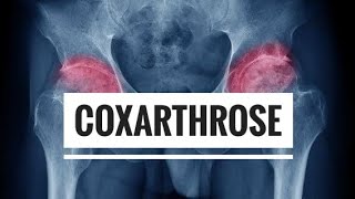 LArthrose  partie 03 Coxarthrose [upl. by Xaviera]