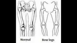 How to Fix bow legs amp Knock knees genu varum Bow Legs surgery  free Remedy  Bowlegs Correction [upl. by Nongim]