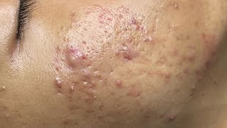 ACNE TREATMENT VU QUYNH MI Acne On Boys Chin 2024 [upl. by Ahsatniuq]