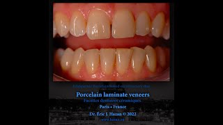 Feldspathic Porcelain baked on refractory dies by Dr Eric Hazan eh22x1 [upl. by Materse]