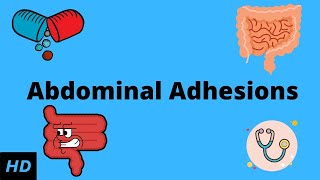 Abdominal Adhesions Causes Signs and Symptoms Diagnosis and Treatment [upl. by Nylednarb]