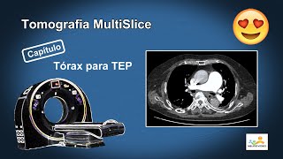 Tomografia Angio de Artérias Pulmonares TEP [upl. by Yaffit]