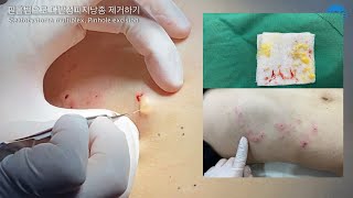 Steatocystoma multiplex Pinhole excision 다발성피지낭종 핀홀법 [upl. by Romeo]