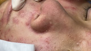 blackheads all over  dermacool 0121 [upl. by Gerty569]