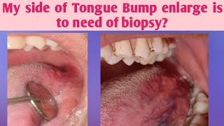 Tongue bump pain swelling irritationMy Side of Tongue papillae enlarge is to need of biopsyTongue [upl. by Lorin]