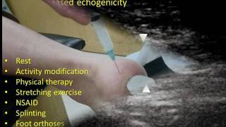 UltrasoundGuided Diagnosis and Treatment of Plantar Fasciitis [upl. by Roarke]