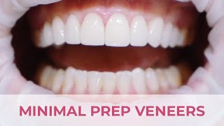 Minimal Preparation Porcelain Veneers Smile Transformation [upl. by Tiloine]