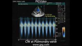 echocardiogram of severe pulmonary stenosis [upl. by Sessilu930]