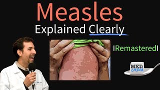 Measles Symptoms Diagnosis Vaccine Treatment Explained [upl. by Maynord]