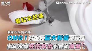 【OMG！背上長巨大粉瘤壓神經 劃開皮膚狂挖夾出光看就痛爆！】｜cherryqueen8462 [upl. by Casia]