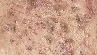 Blackheads amp Whiteheads Satisfying Removal 0077 [upl. by Essilevi]