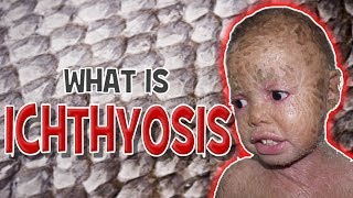 What is Ichthyosis  Cause Symptoms amp Treatment [upl. by Nivan]