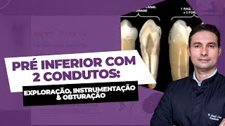 Anatomia em Endodontia  Pré Molar Inferior com 2 condutos [upl. by Phelgon]