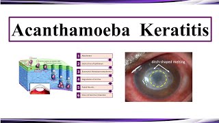 Acanthamoeba Keratitis [upl. by Nannahs589]