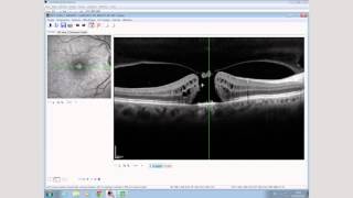 Case Study with SPECTRALIS OCT Macular Hole [upl. by Squire572]