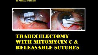 TRABECULECTOMY WITH MITOMYCIN C amp RELEASABLE SUTURES [upl. by Zysk697]