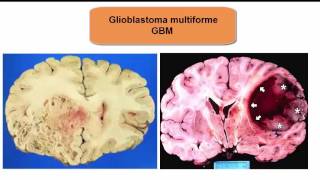 Glioblastoma Multiforme what you need to know [upl. by Fasta]