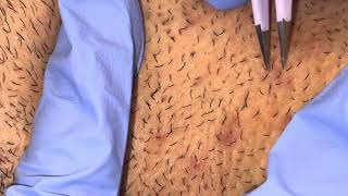 Ingrown Hairs Plucked from Beard [upl. by Anitnahs307]