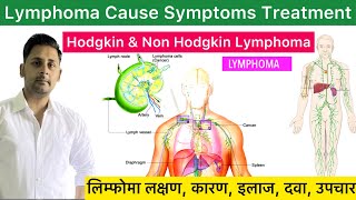 Lymphoma Cause Symptom Diagnose Treatment in Hindi  Hodgkin amp Non Hodgkin Lymphoma  Lymphoma Hindi [upl. by Alaekim808]