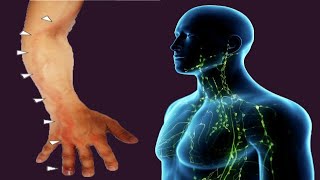 Lymphangitis Causes And Symptoms [upl. by Ailuig]