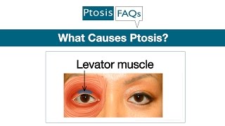 What Causes Ptosis Explained by Oculoplastic Surgeon Dr Amiya Prasad [upl. by Roswell]