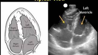 How to Cardiac Ultrasound  Apical View Case Study [upl. by Anaimad]