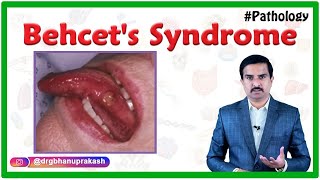 Behcets syndromeBehcet Disease  Etiology Pathogenesis Clinical features Diagnosis amp Treatment [upl. by Shandeigh472]