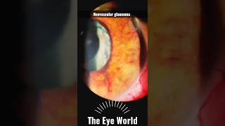 Neovascular glaucoma [upl. by Amarette]