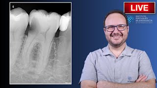 Tx of 🦷46 with Irreversible Pulpitis and huge caries ▶️ Part 1  CASE172 [upl. by Airdnahs]