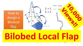 How to design a bilobed local flap [upl. by Yuji]