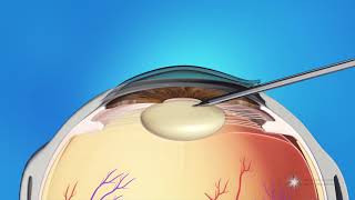 Phacoemulsification Cataract Surgery [upl. by Milstone322]