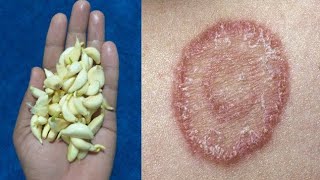 दाद खाज खुजली Ringworm कि 3 दिन में छुट्टी कर देगा  fungal infection ka ilaj  daad khaj khujli [upl. by Nodnarbal]