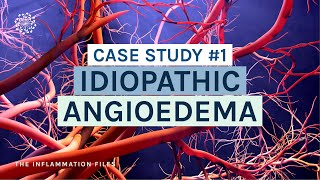 Idiopathic Angioedema  Case Study 1 The Inflammation Files with Dr Kara Wada [upl. by Llenrod]