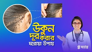 মাত্র ১ দিনেই উকুন দূর করার উপায় — ডা তাসনিম জারা চিকিৎসক ইংল্যান্ড [upl. by Phemia]