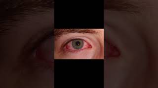 Conjunctivitis  Common eye conditions during cold months [upl. by Madaih185]