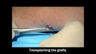 Pinch Skin Grafting [upl. by Jak28]