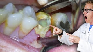 Badly Infected Tooth Extraction Procedure With Pus Coming Out of The Tooth [upl. by Dedie48]