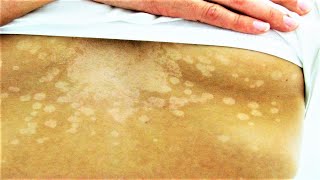 Tinea Versicolor Diagnosis and Treatment  Treating Fungus on the Skin [upl. by Gorden265]