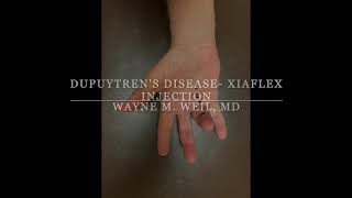 Dupuytren’s Disease Treatment with Xiaflex [upl. by Adnorrehs]