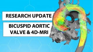 Bicuspid Aortic Valve Research Using 4D Flow MRI to Predict Aorta Dilation with Dr Michael Markl [upl. by Yvehc]