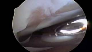 Chondroplasty  Cartilage Knee Surgery by Dr Steven Struhl [upl. by Urita]